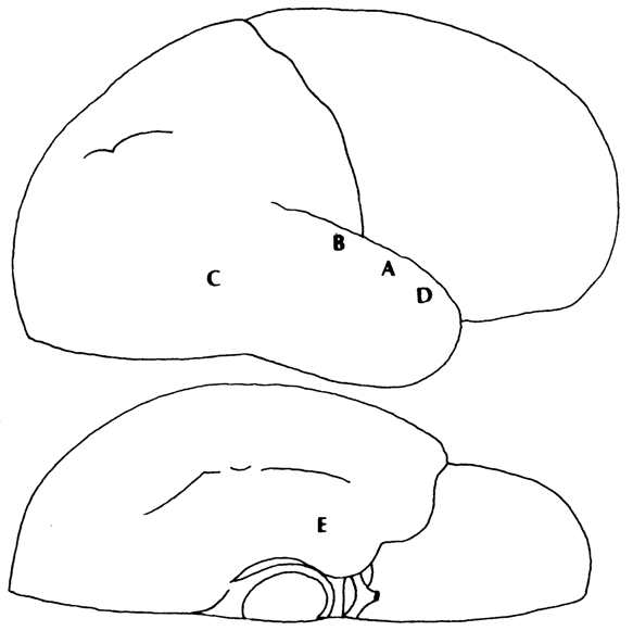 Figura 4. Diagrama del cerebro de uno de los pacientes epilépticos de Penfield